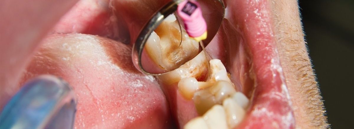 Diş Estetik Dolgu Fiyatları 2026 (2)