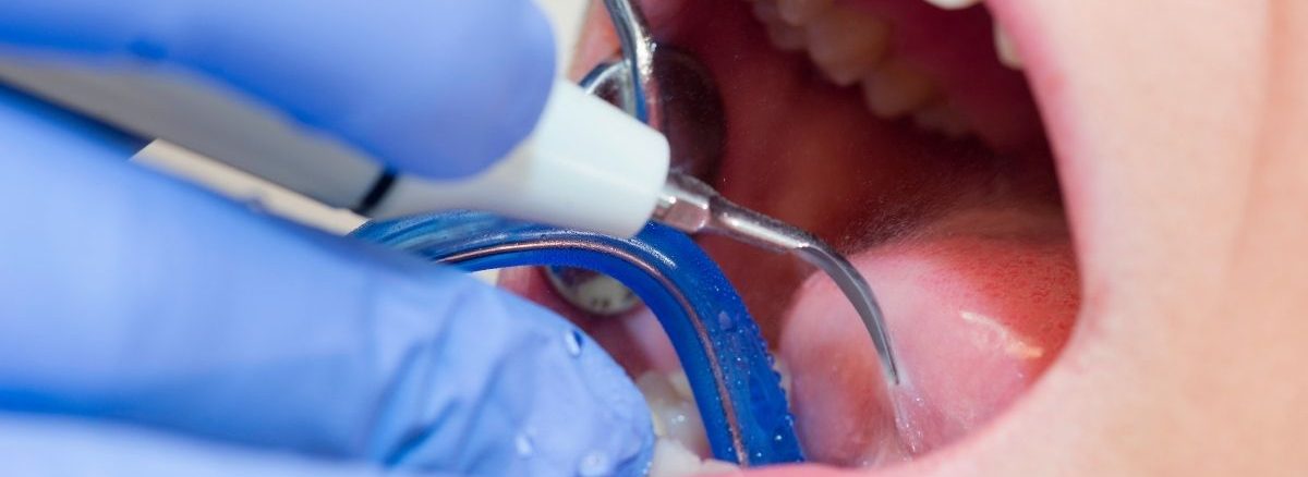 Diş taşı temizliği Fiyatları (2)