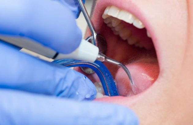 Diş taşı temizliği Fiyatları (2)