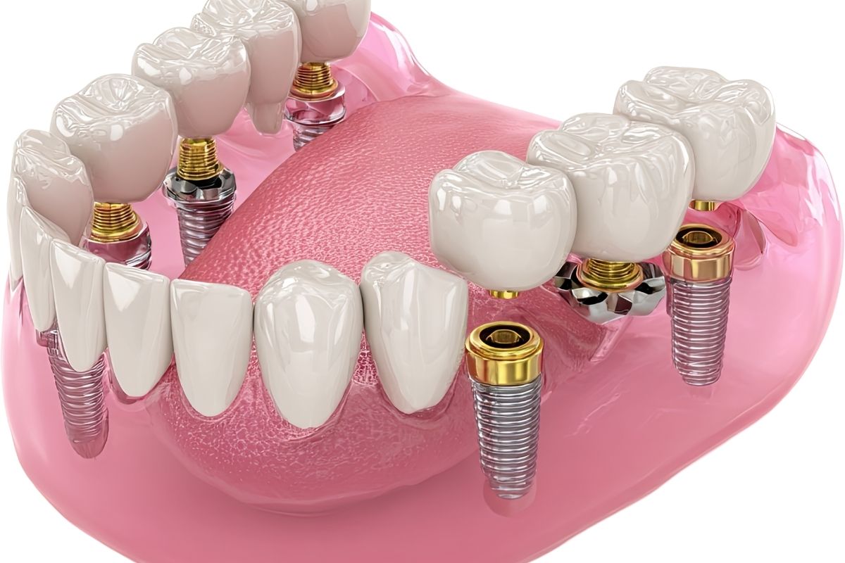 implant Nişantaşı 
