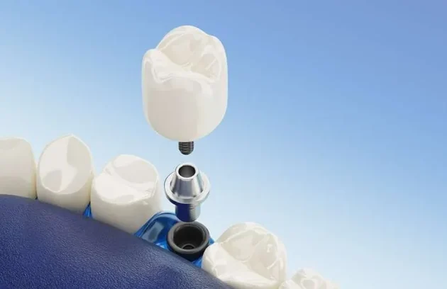 ایمپلنت دندان در استانبول