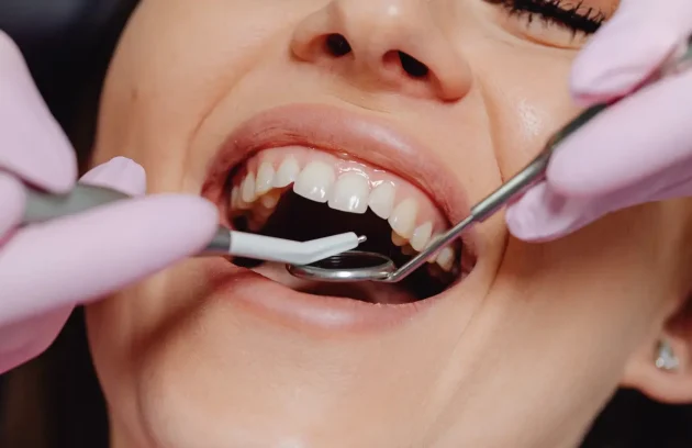 روکش‌های دندان در استانبول