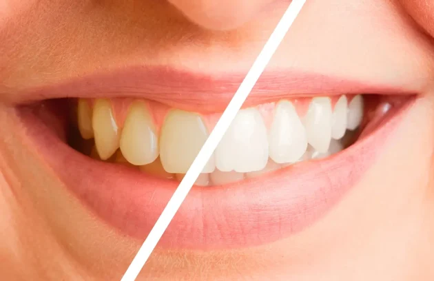   هزینه بلیچینگ دندان در استانبول